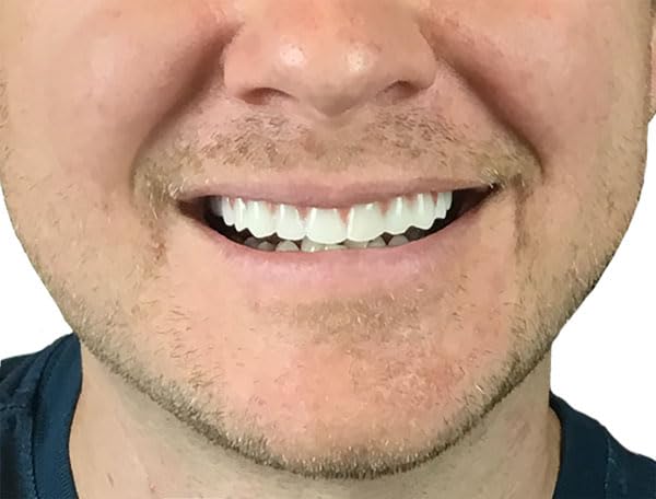 Instant Smile Comfort Fit Flex Teeth - Natural Look

