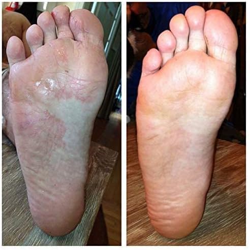 Toenail Fungus Treatment Extra Strength Foot Deodorizer

