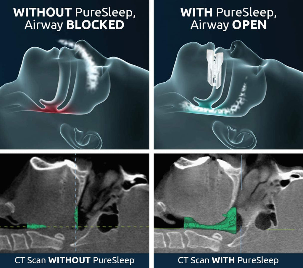 PureSleep Original Anti-Snoring Mouthpiece | FDA-Cleared

