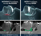 PureSleep Original Anti-Snoring Mouthpiece | FDA-Cleared

