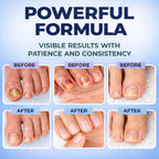 Toenail Fungus Treatment Pen - Extra Strength, FSA/HSA Eligible

