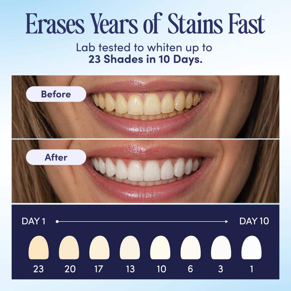 BocaBella Teeth Whitening Trays U-Wraps Enamel-Safe Formula

