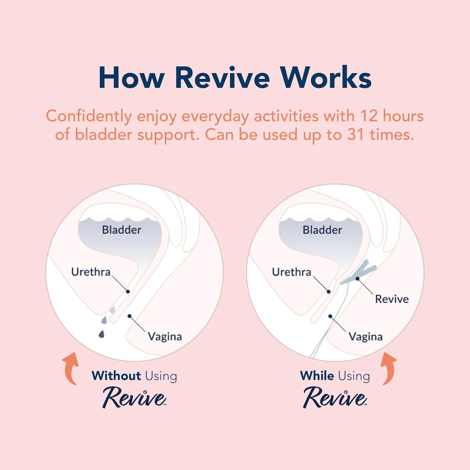 Revive Bladder Support Pessary for Women | SUI Device

