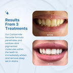 Teeth Whitening Kit by PurelyWHITE Deluxe

