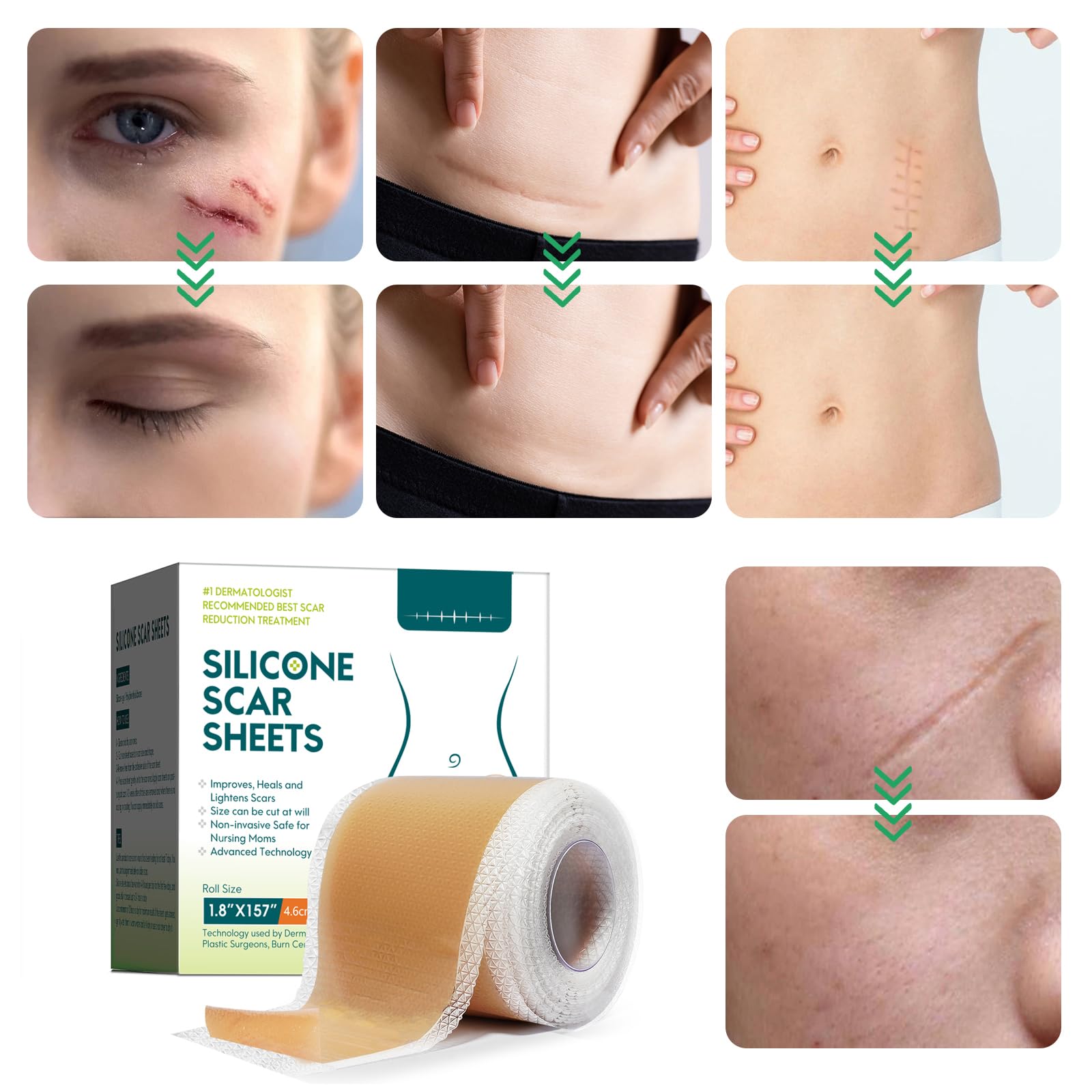 Medical Grade Silicone Therapy for Skin Healing

