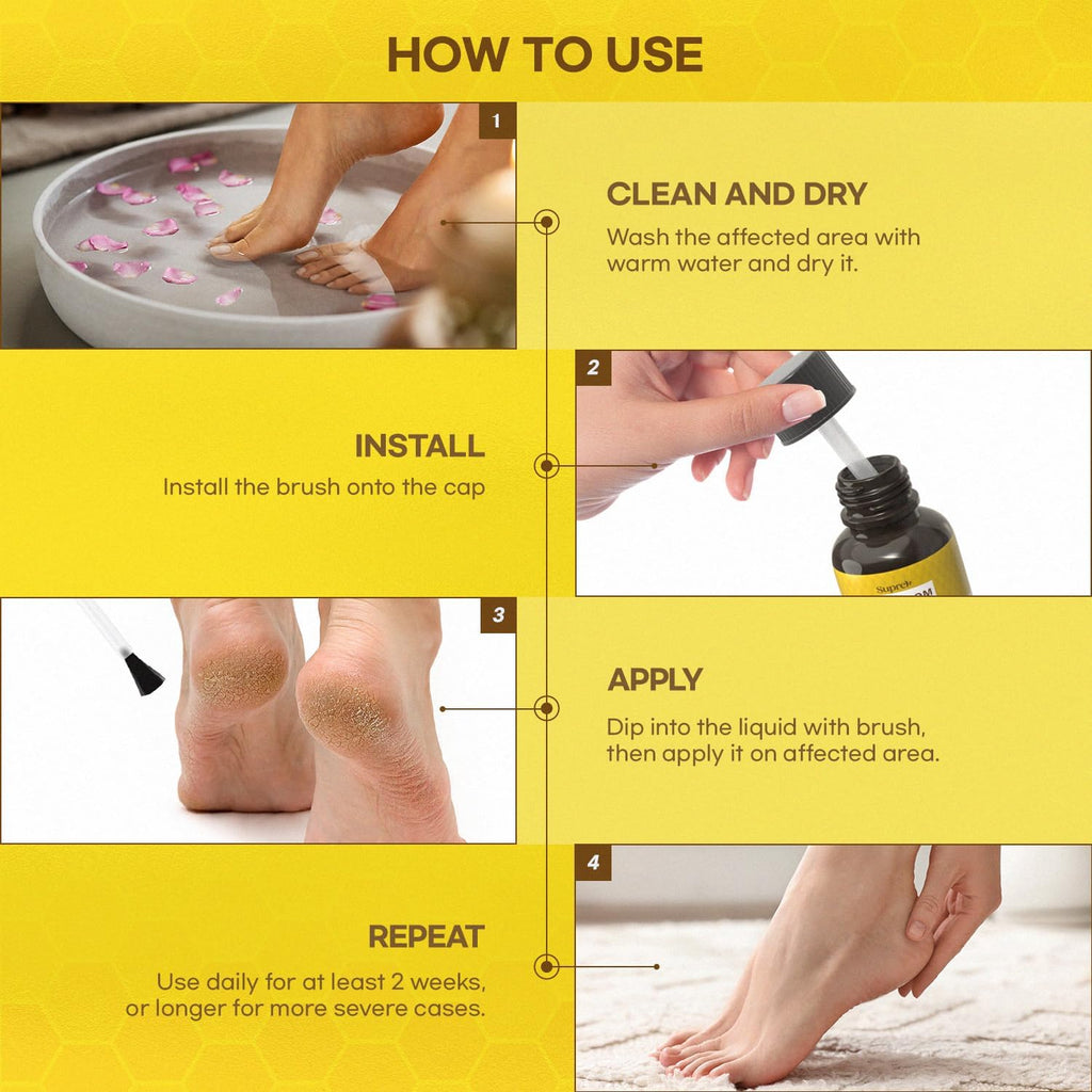 SupreH Bee Venom Wart Remover with Salicylic Acid

