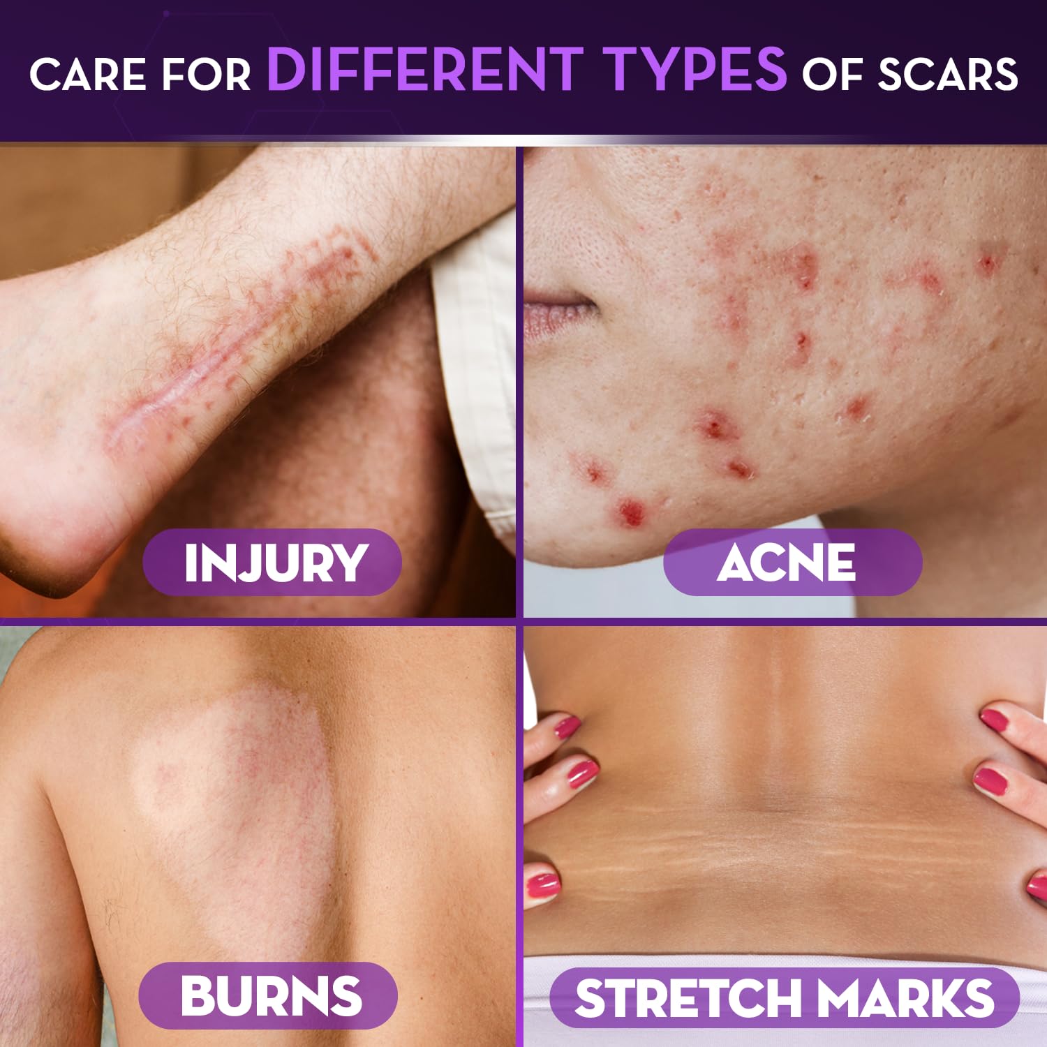 Cicatricure Advanced Scar Gel for Face & Body | Proven

