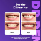 DRDENT Purple Teeth Whitening System | Safe for Enamel

