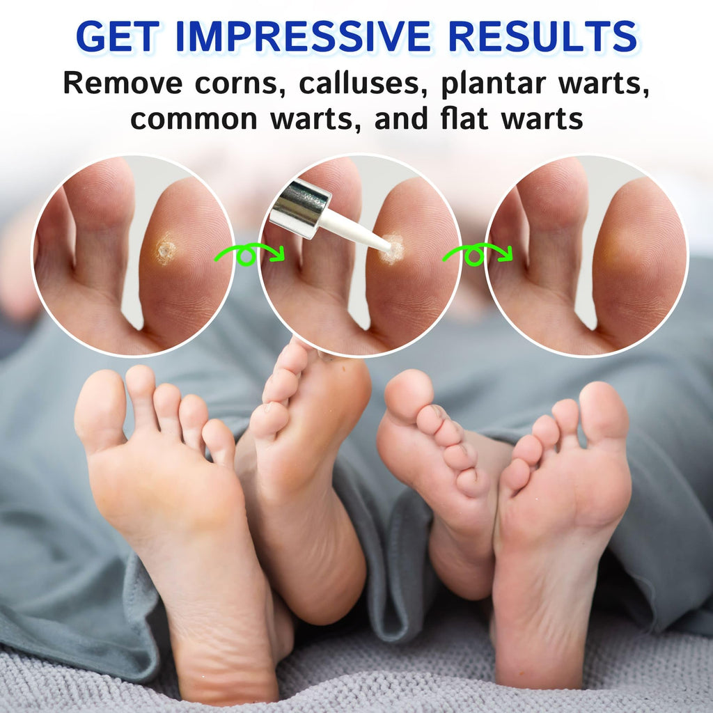 Ulensy Corn Remover Liquid for Feet with Salicylic Acid


