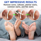 Ulensy Corn Remover Liquid for Feet with Salicylic Acid


