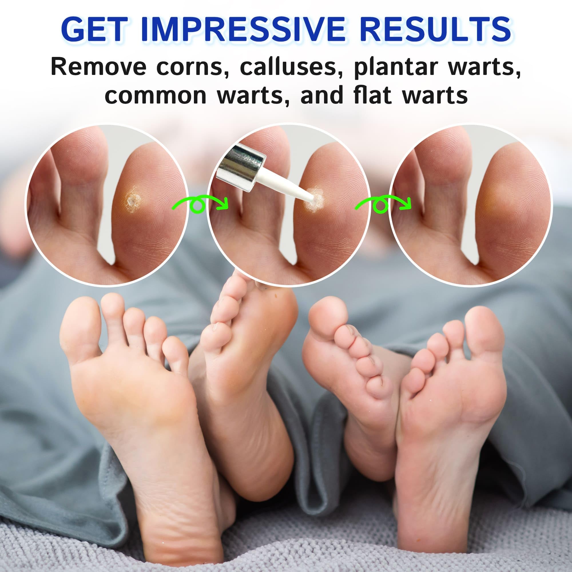Ulensy Corn Remover Liquid for Feet with Salicylic Acid

