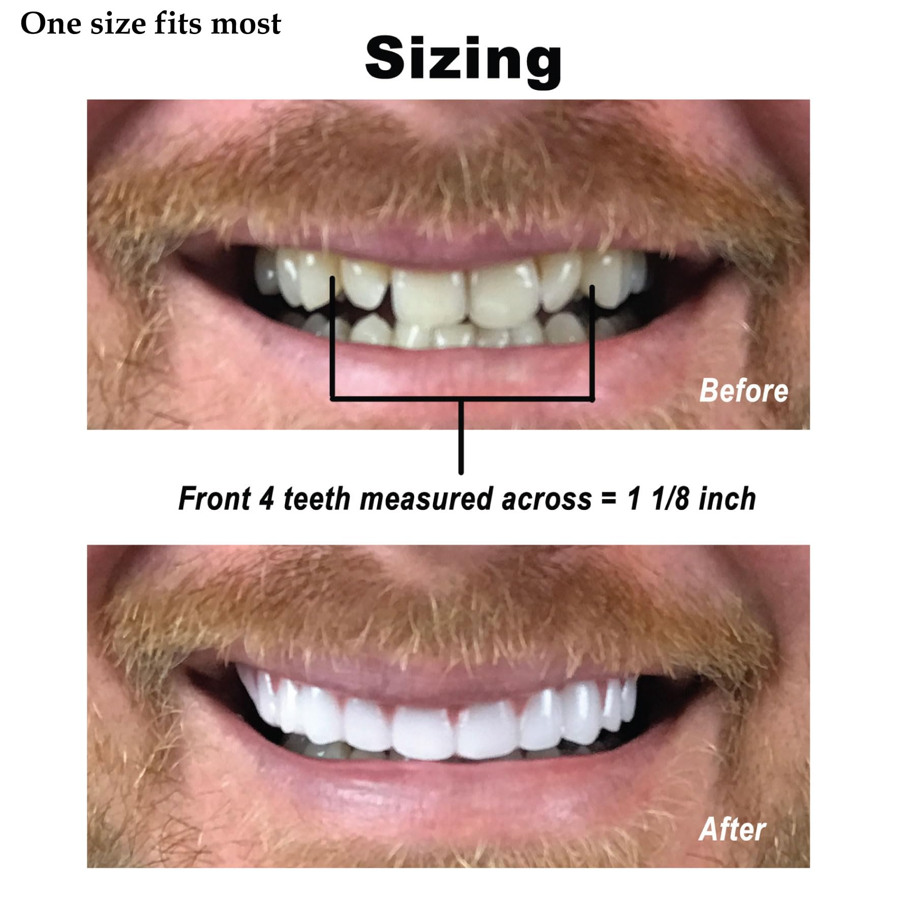 Instant Smile Cosmetic Teeth

