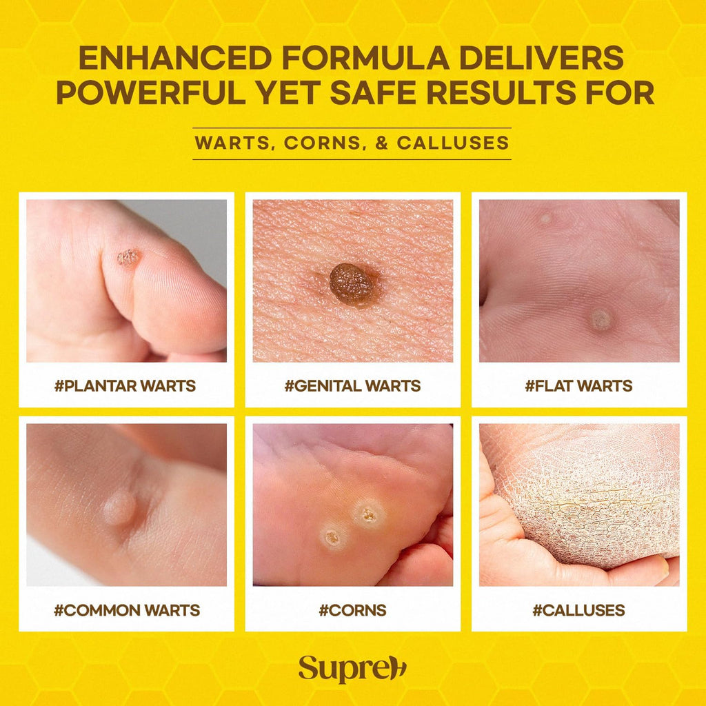 SupreH Bee Venom Wart Remover with Salicylic Acid

