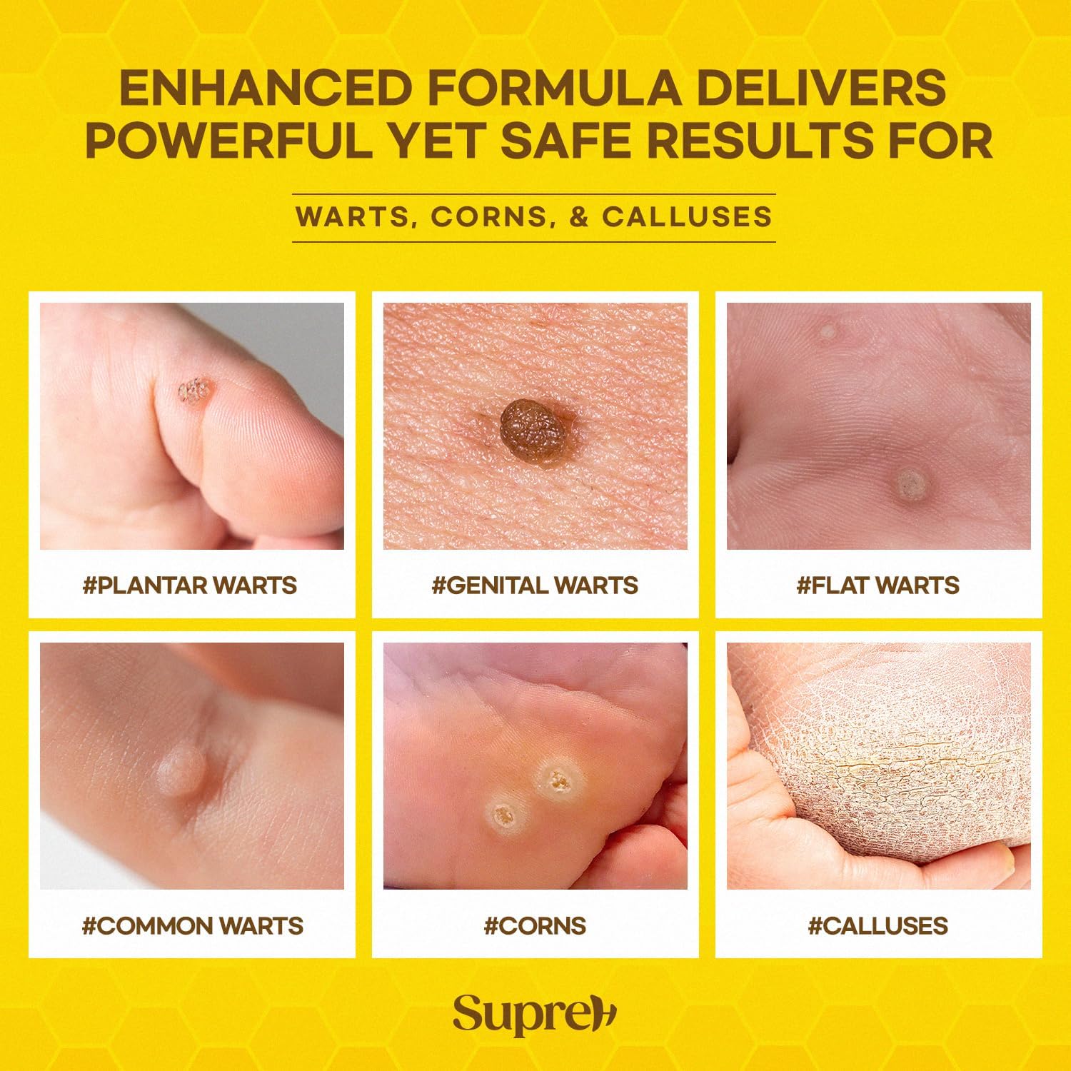 SupreH Bee Venom Wart Remover with Salicylic Acid

