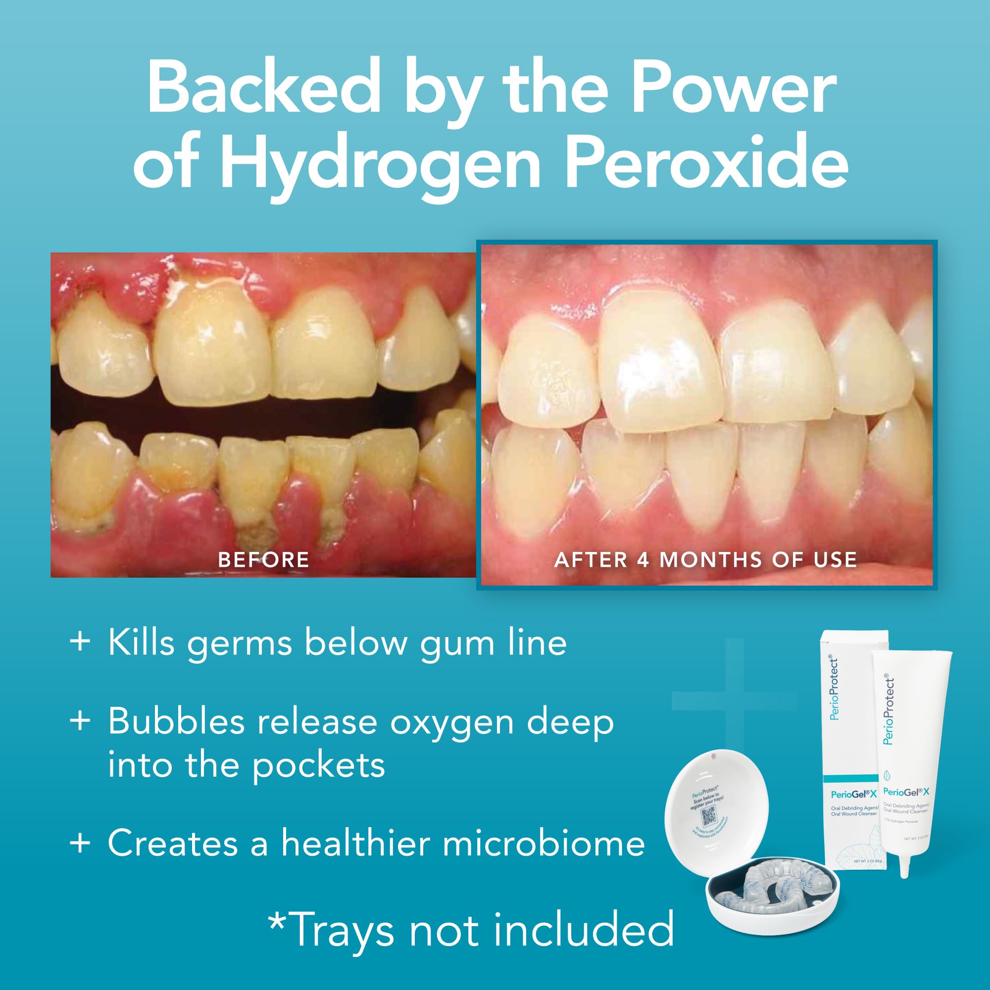 PerioGelX Periodontal Treatment - Teeth Whitening

