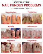 Toenail Fungus Treatment Extra Strength with 25% Undecylenic


