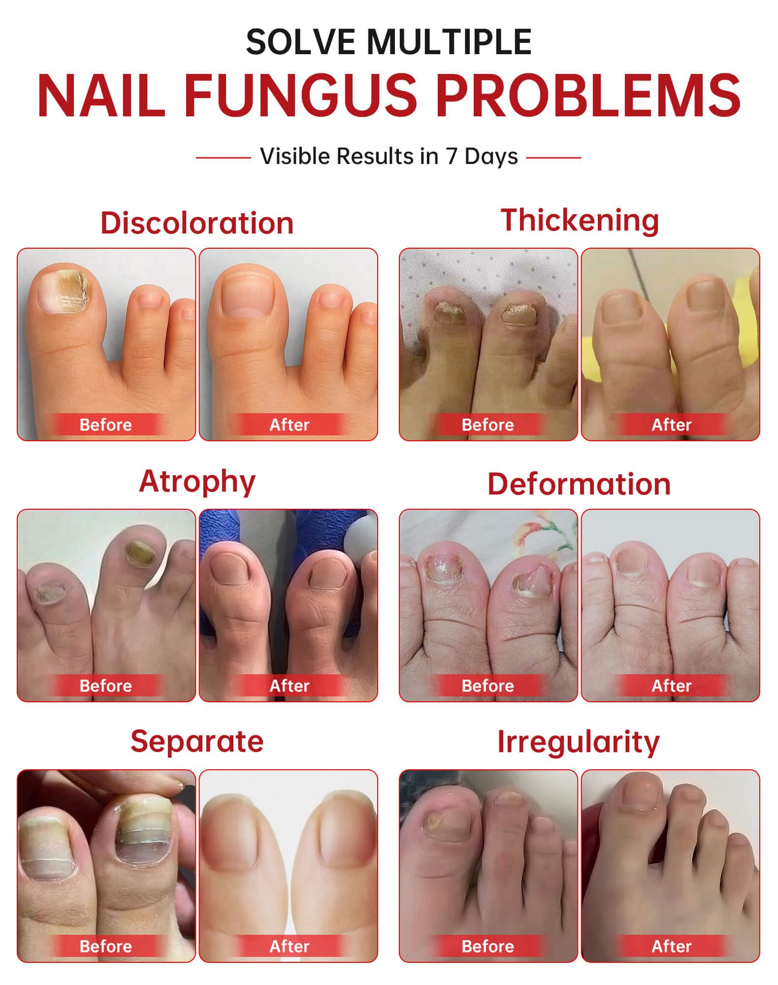 Toenail Fungus Treatment Extra Strength with 25% Undecylenic

