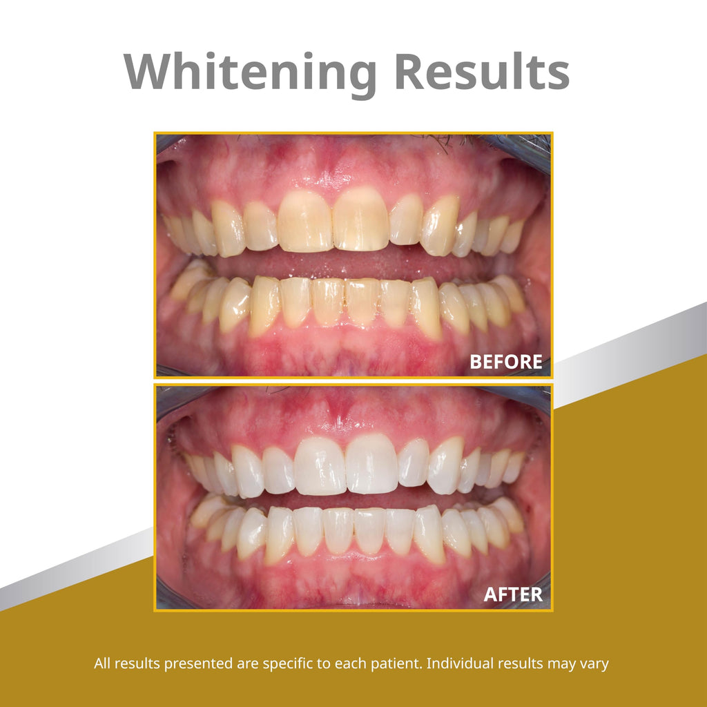 Opalescence Teeth Whitening Gel Refill Kit - Ultradent

