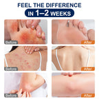 Antifungal Cream Kerova 2% Miconazole for Jock Itch

