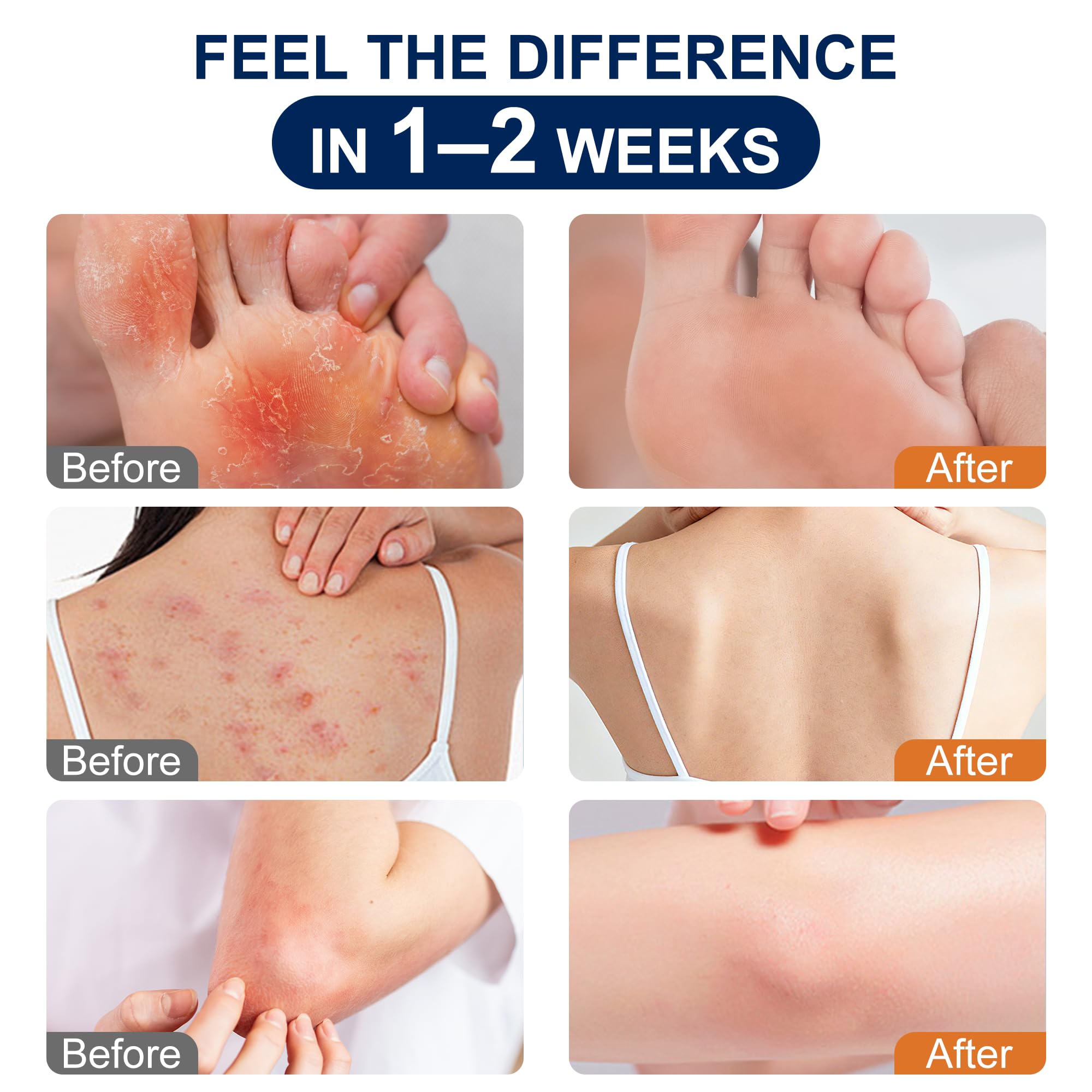 Antifungal Cream Kerova 2% Miconazole for Jock Itch

