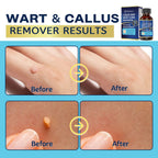 MEOLY Wart Remover - Fast-Acting Maximum Strength

