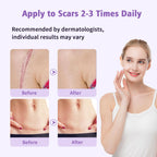 Medical Grade Silicone Scar Gel for Surgical & Acne Scars

