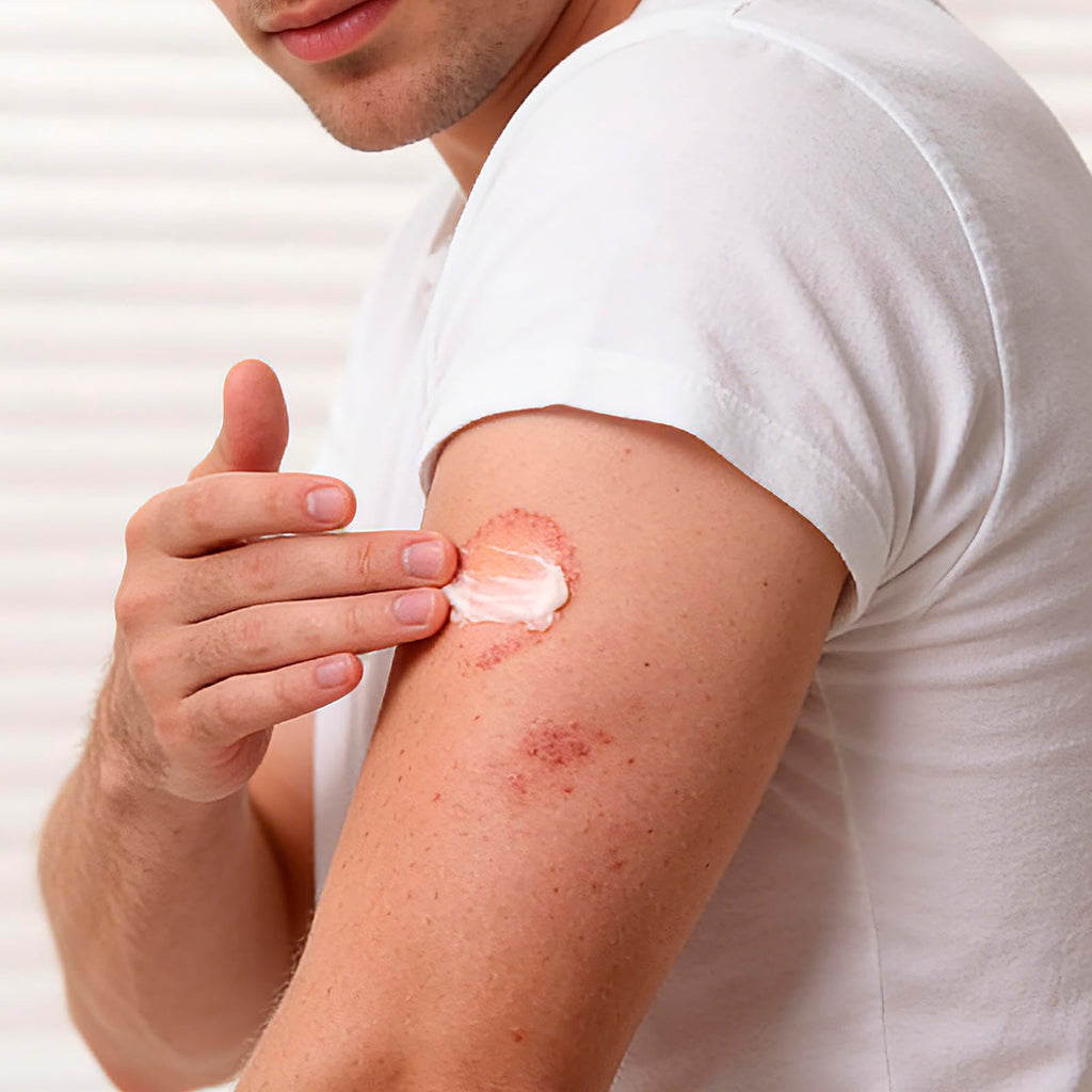 Antifungal Cream Kerova 2% Miconazole for Jock Itch

