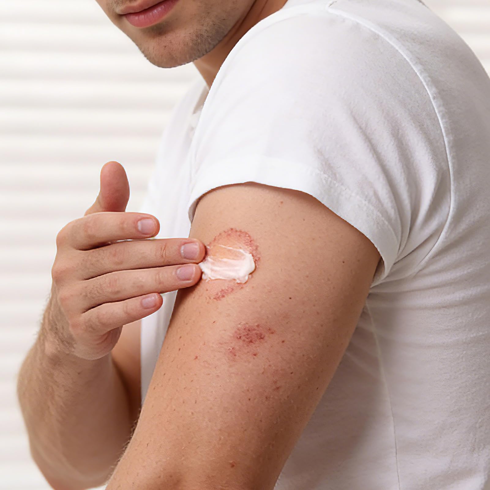 Antifungal Cream Kerova 2% Miconazole for Jock Itch

