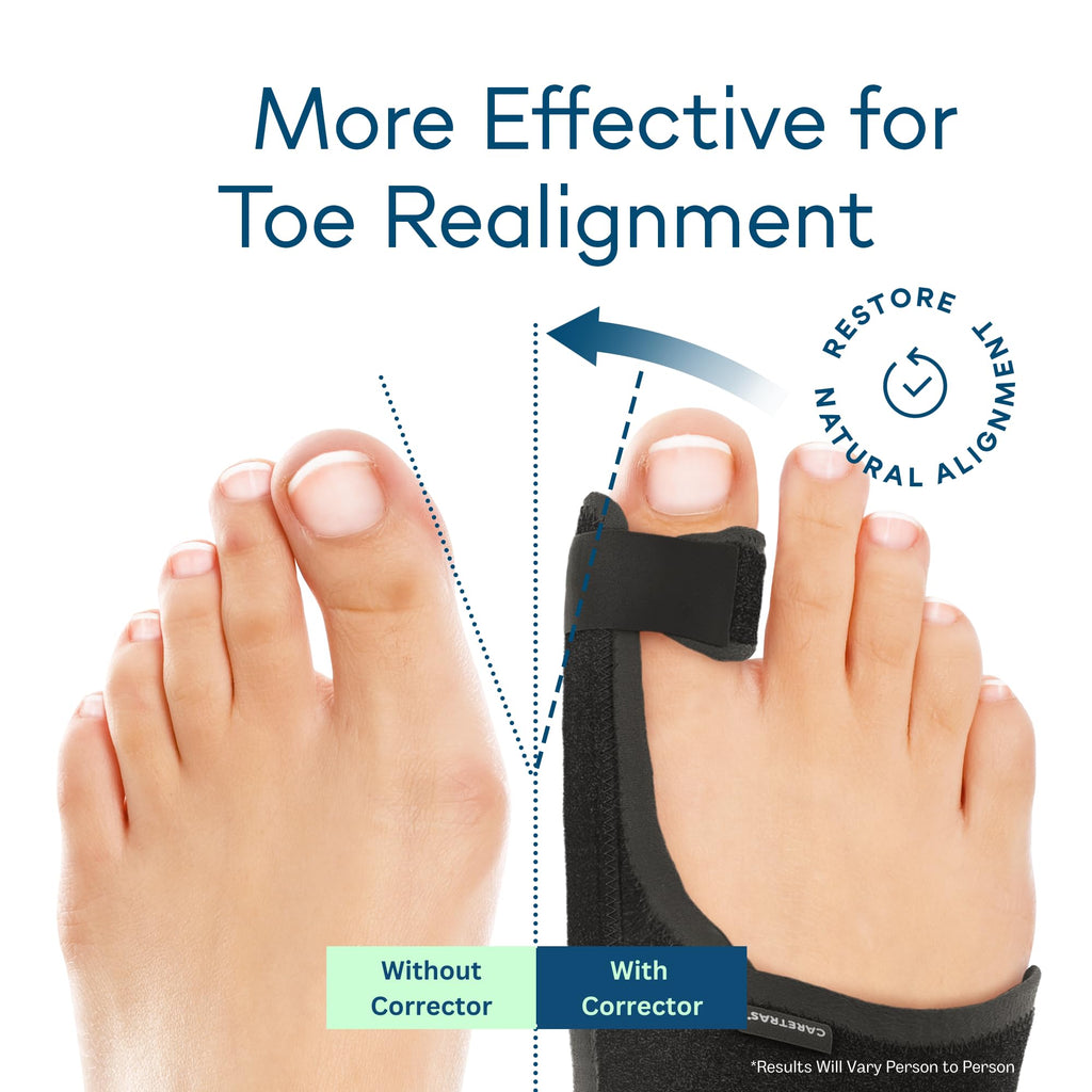 Caretras Bunion Corrector | Toe Alignment & Comfort

