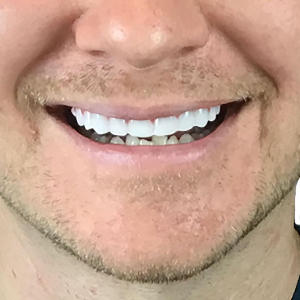 Instant Smile Cosmetic Teeth

