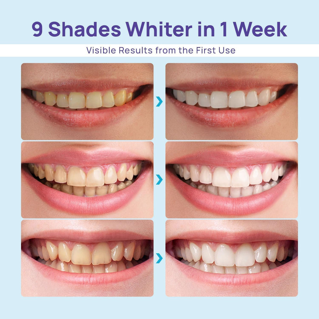 WhiteBite Pro Teeth Whitening Kit for Sensitive Teeth

