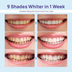 WhiteBite Pro Teeth Whitening Kit for Sensitive Teeth

