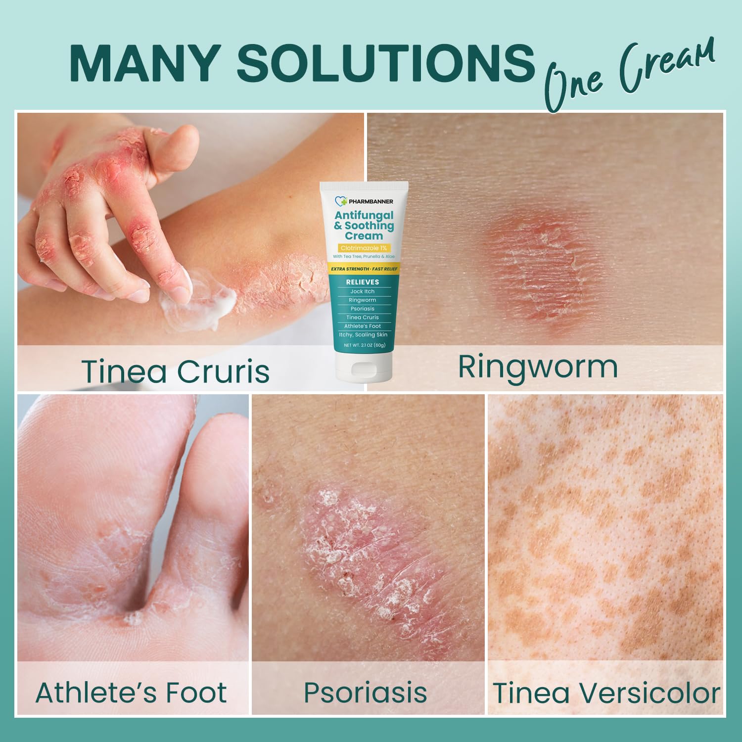 Antifungal Cream for Itchy Skin | Fast Relief

