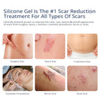Silicone Scar Gel by Murasaki Beauty for Surgical Scars

