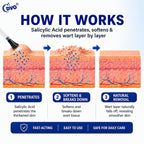 DVO Wart Remover Liquid Maximum Strength Fast-Acting

