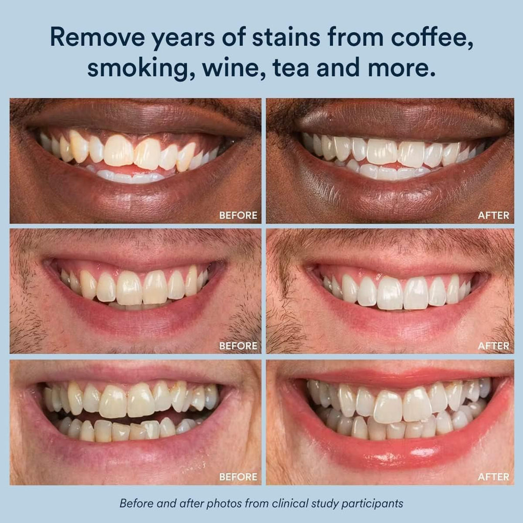 Auraglow Teeth Whitening Gel for Trays & Aligners


