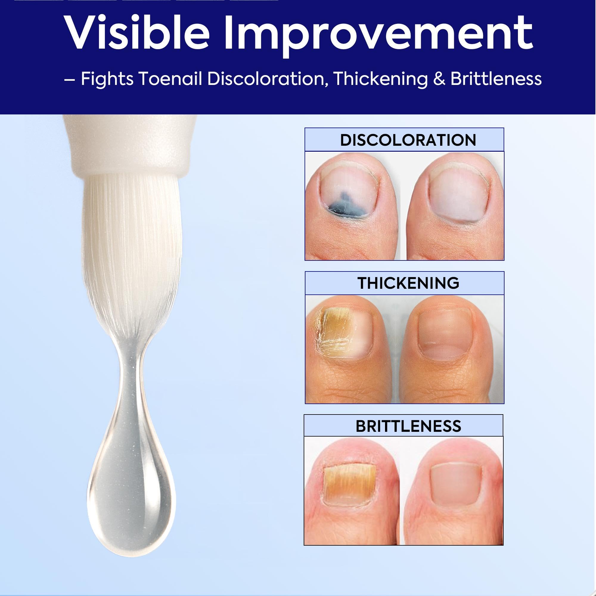 Nail Care Solution Kit for Thick Brittle Nails

