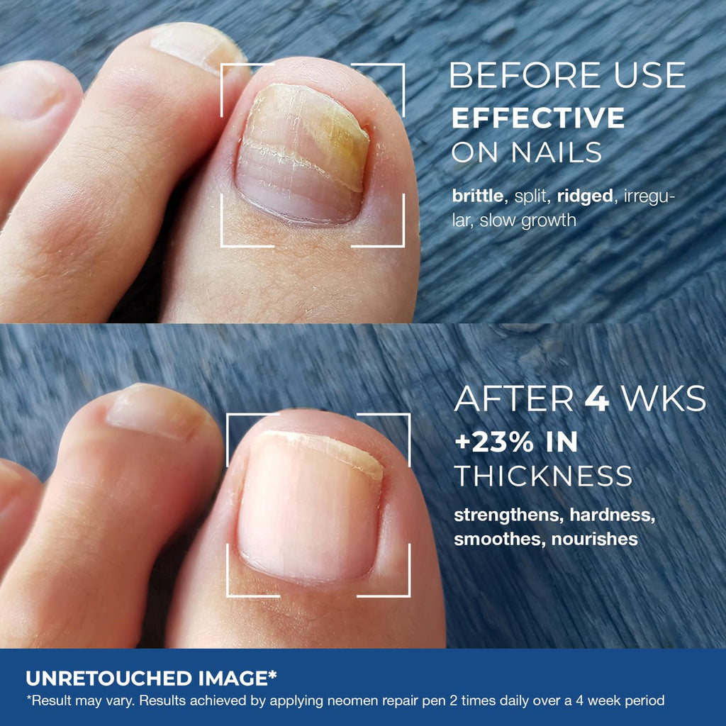 Nail Fungus Pen - Toenail & Fingernail Treatment

