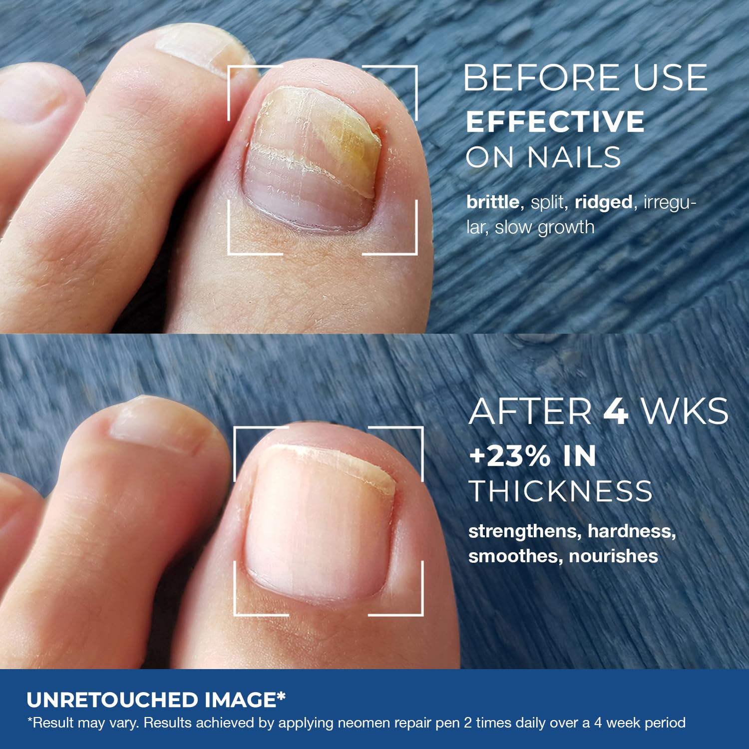 Nail Fungus Pen - Toenail & Fingernail Treatment

