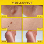 SupreH Bee Venom Wart Remover with Salicylic Acid

