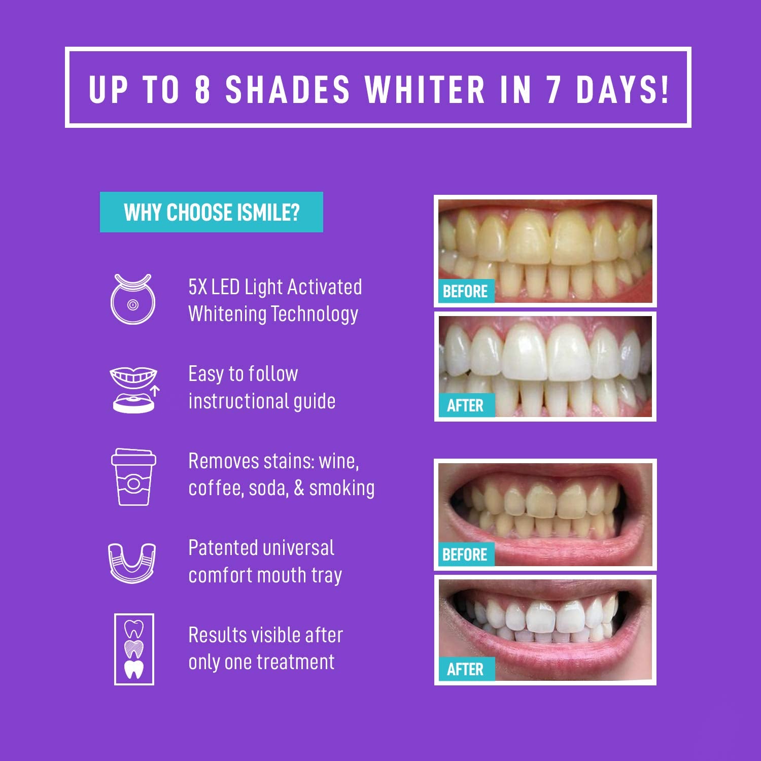 iSmile Teeth Whitening Kit for At-Home Use

