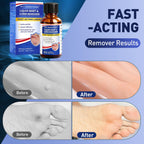 Wart Remover Liquid for Warts

