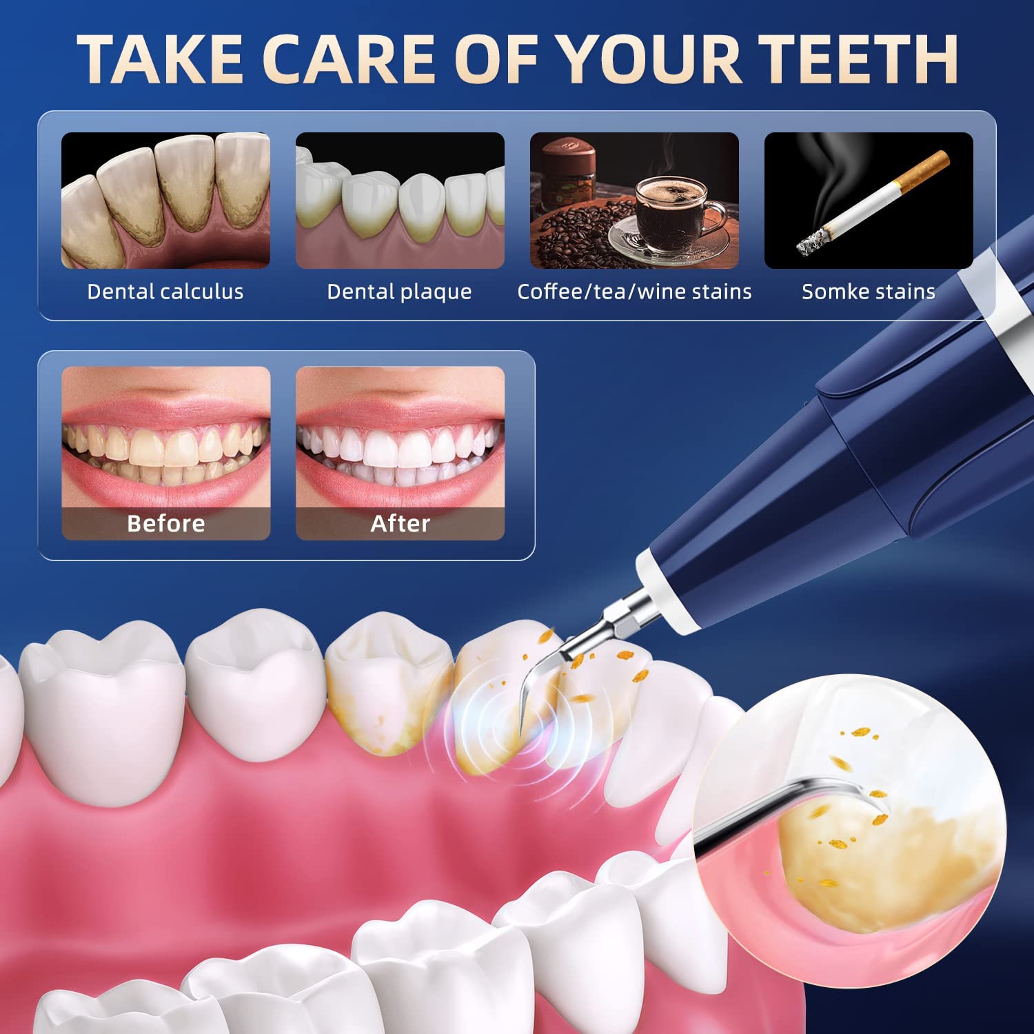 Plaque Remover for Teeth - Tartar Cleaning Kit

