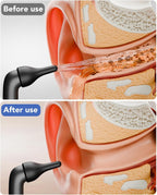 Yakbio Ear Wax Removal Kit - Safe Ear Cleaning

