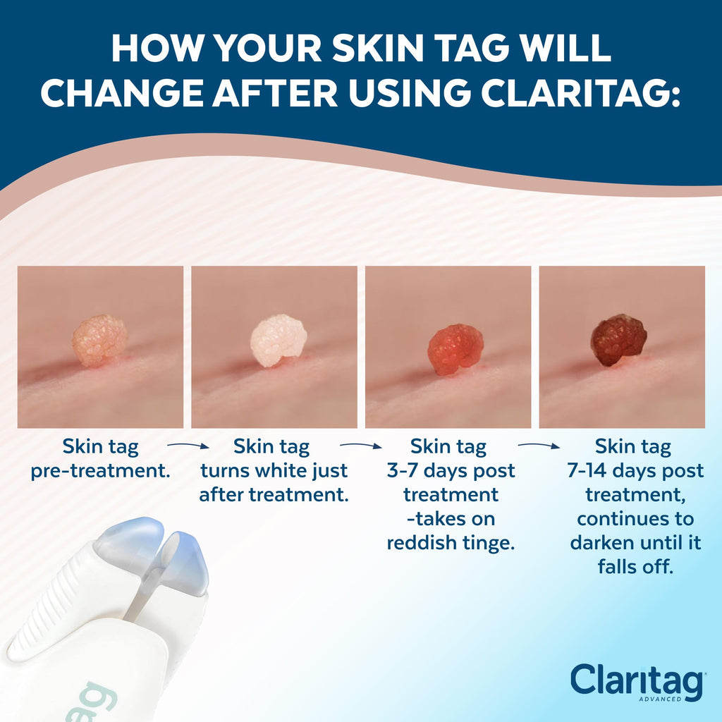 Claritag Skin Tag Remover - At-Home Use

