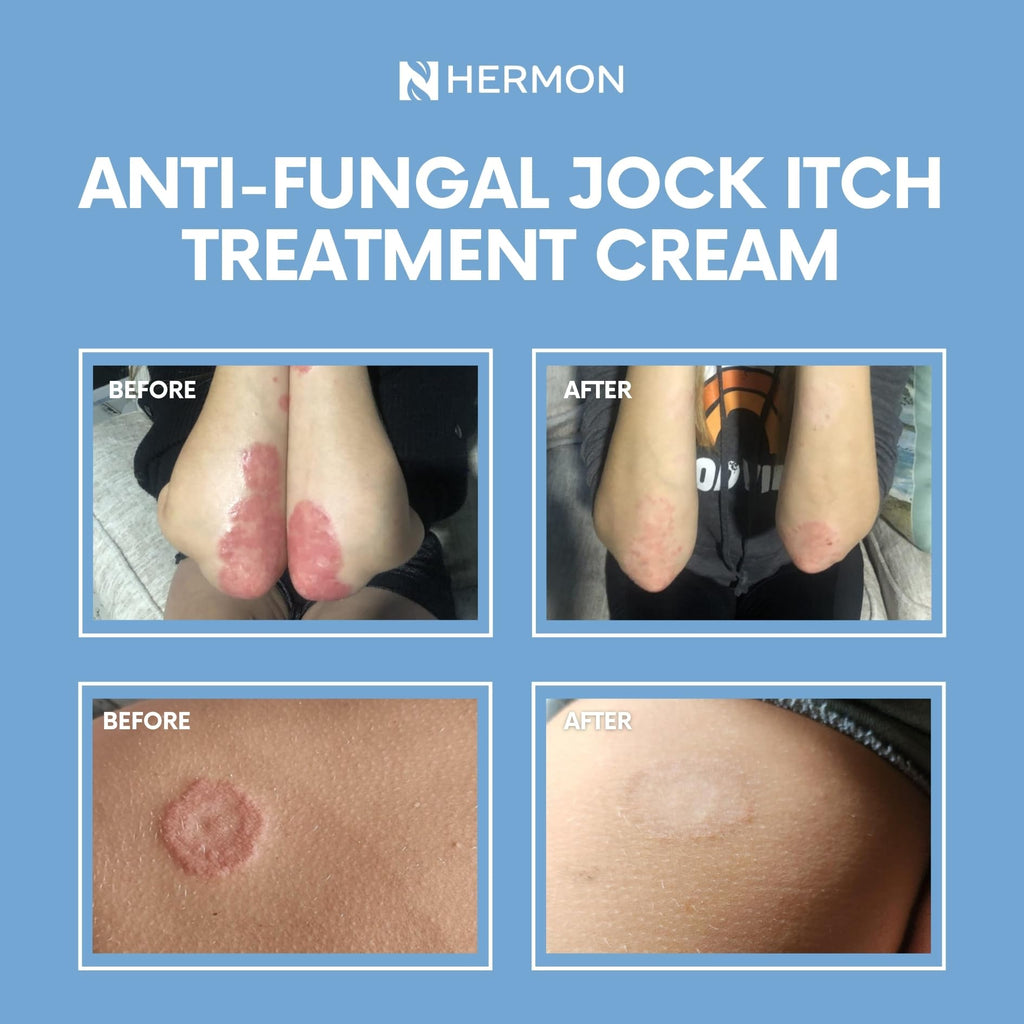 Hermon Jock Itch Cream – Ringworm & Athlete's Foot

