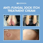 Hermon Jock Itch Cream – Ringworm & Athlete's Foot

