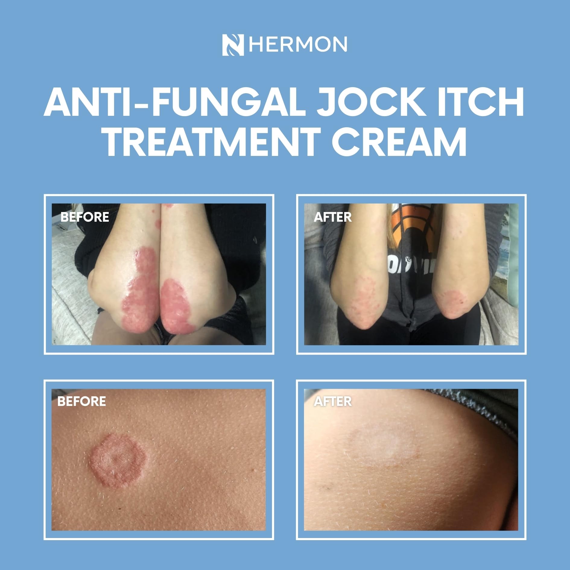 Hermon Jock Itch Cream – Ringworm & Athlete's Foot

