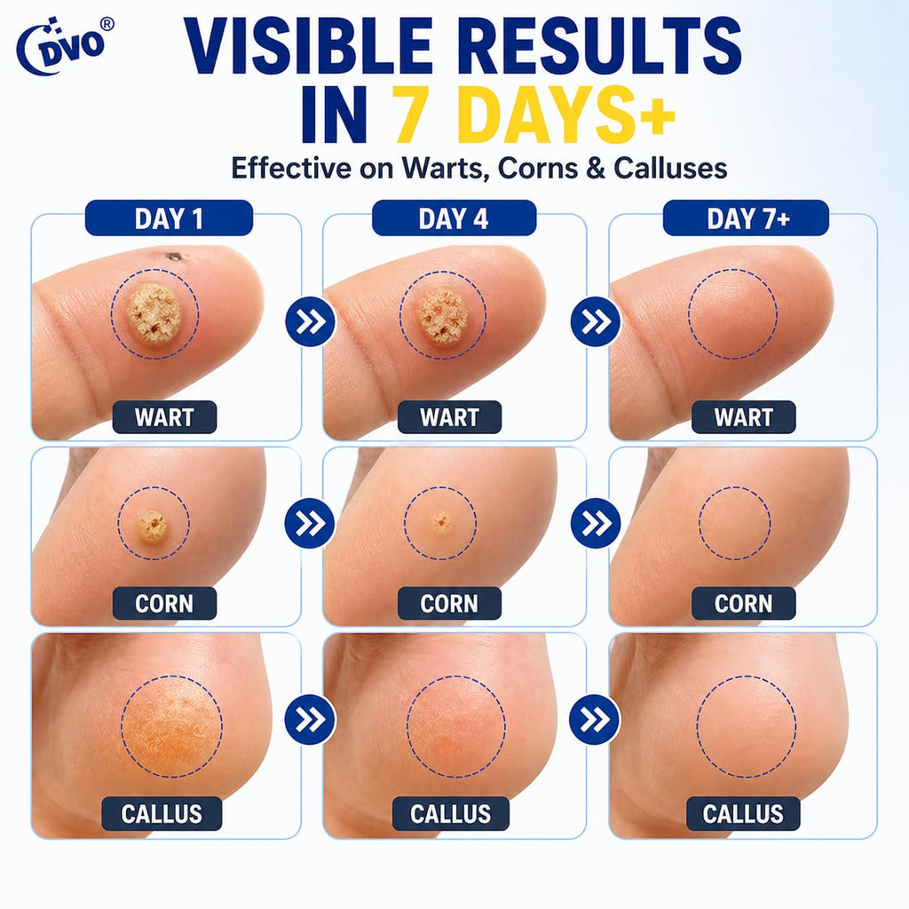DVO Wart Remover Liquid Maximum Strength Fast-Acting

