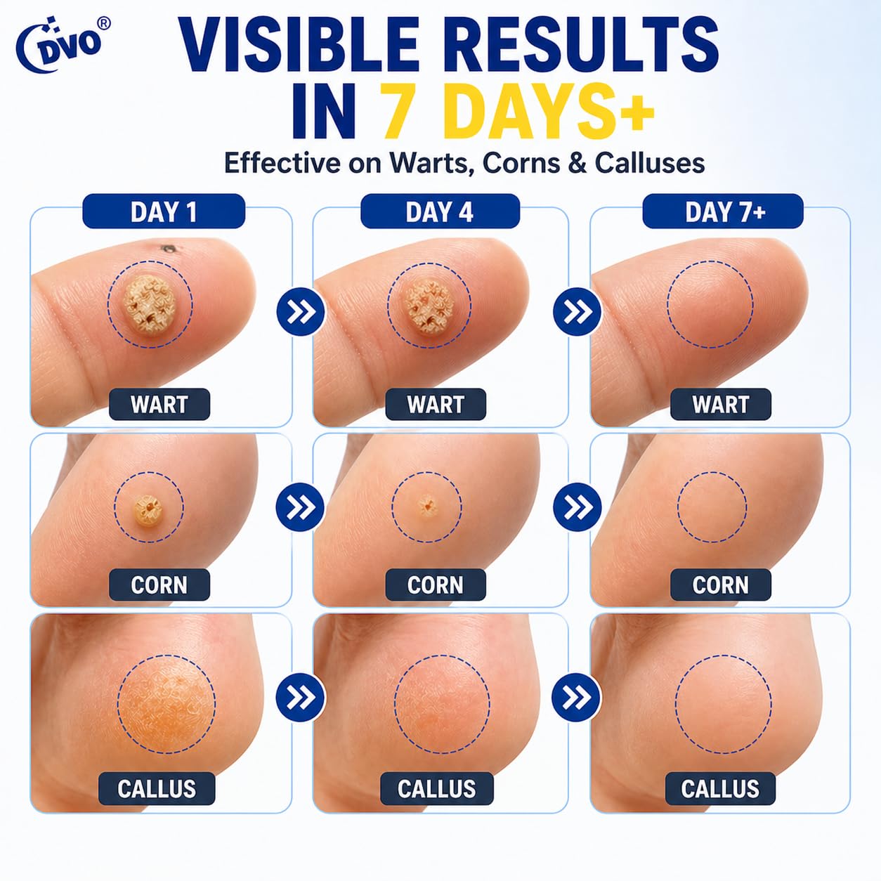 DVO Wart Remover Liquid Maximum Strength Fast-Acting

